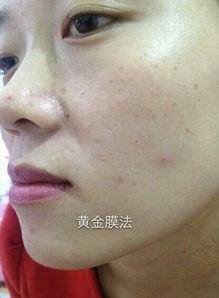 发痘痘图片
